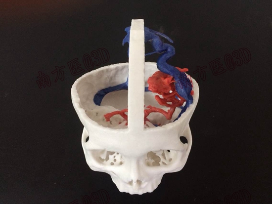 3D打印技术助力脑动静脉畸形实现个体化诊疗.jpg