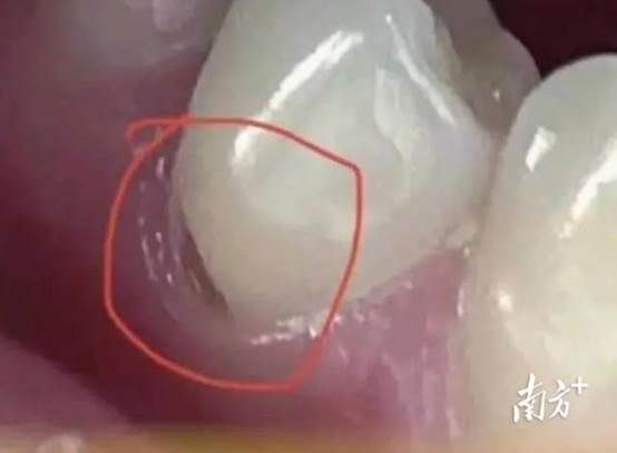 27岁女生因长期横向刷牙导致牙齿出现缺口。